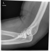 SPORK, NICO - 22.03.1976 - 05.08.2022 - Rö Ellenbogen links - 14:38:20 - ELBOW